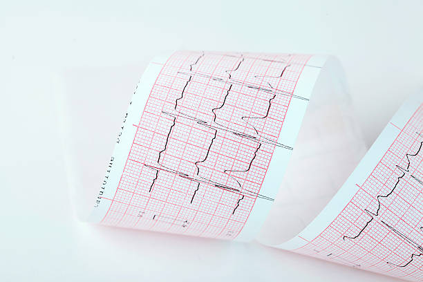 ECG